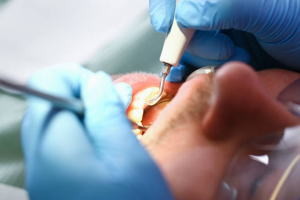 Best Emergency Root Canal Treatment in Johnston City, IL