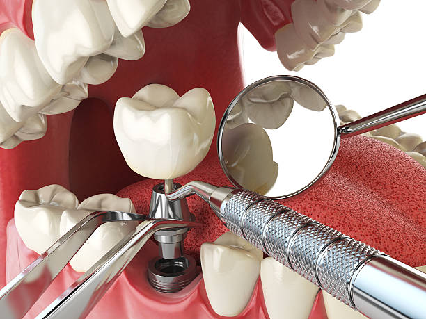 Best Emergency Tooth Extraction in Johnston City, IL
